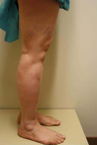 Photo of Legs Pre-Vein Treatment