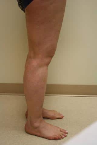 Photo of Legs After Vein Treatement