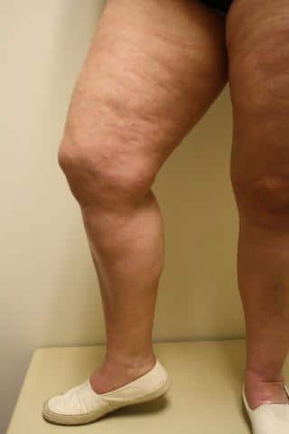 Photo of Legs After Vein Treatement