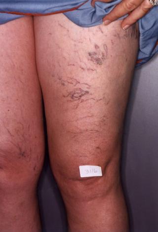Legs before Spider Vein Treatment