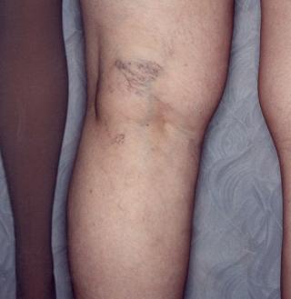 before undergoing vein treatment on back of knee