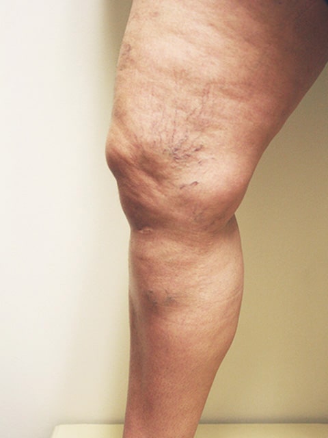 Legs Before Spider vein treatment