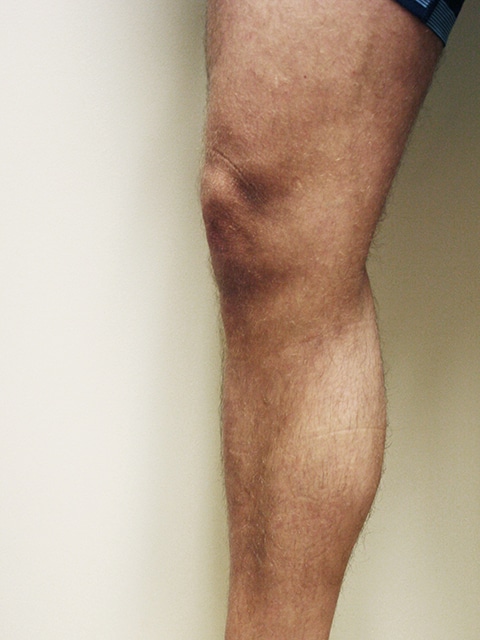 Legs After Varicose vein treatment