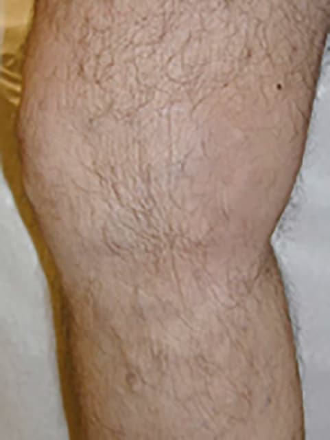 Legs After Varicose vein treatment