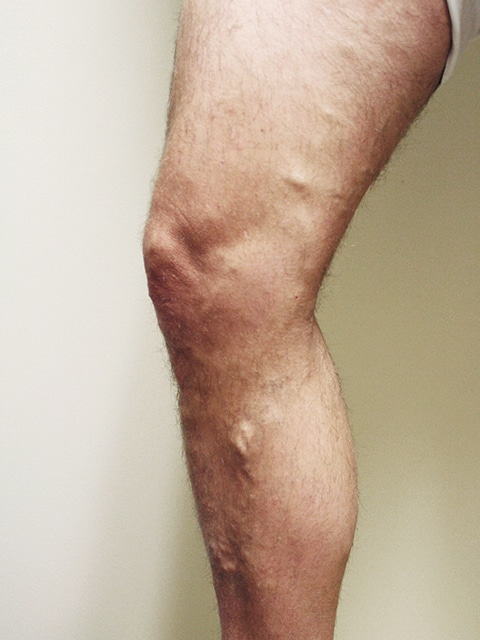 Legs Before Varicose vein treatment